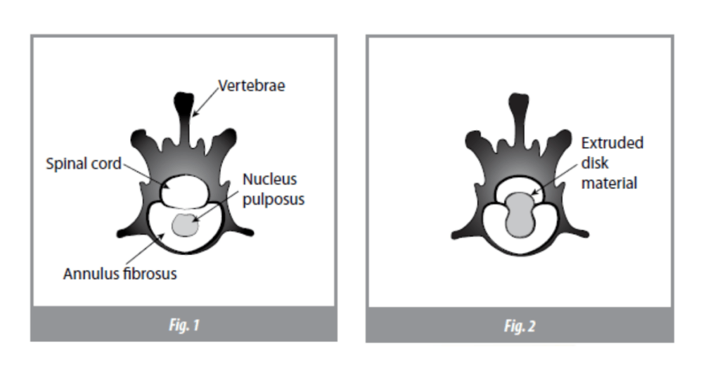 Figures showing intervertebral disk disease (IVDD) in a dog